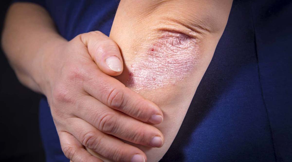 eczema, health, Eczema symptoms